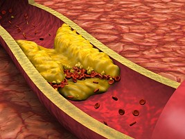 Как холестерин поражает нервную систему