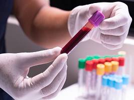 Рассказали в лаборатории: зачем сдавать клинический анализ крови и что говорят отклонения от нормы