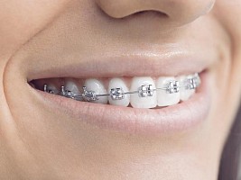 Как устранить промежутки между зубами и почему они появляются
