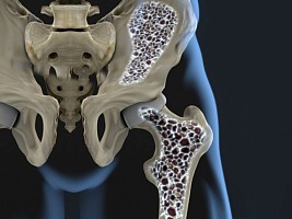 Шесть способов профилактики остеопороза
