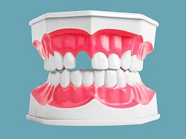 8 проблем со здоровьем, которые вызывает отсутствие зубов