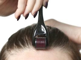 Микронидлинг для кожи головы: помогает ли он остановить выпадение волос