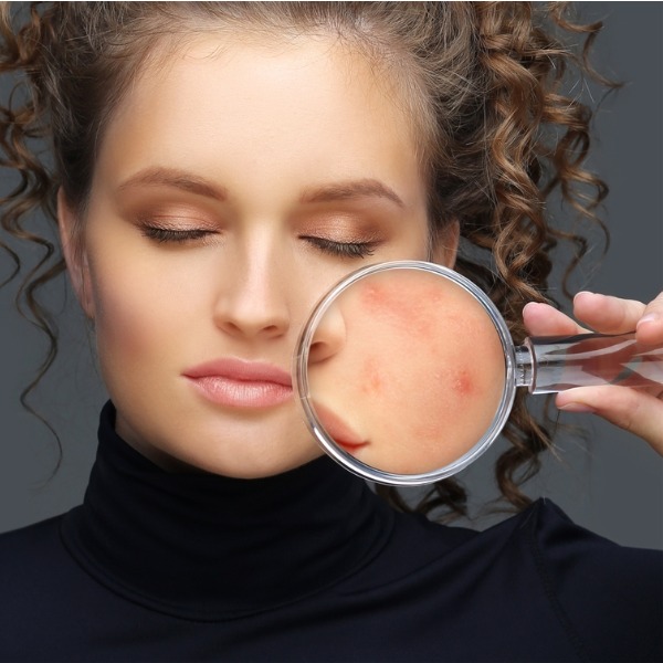 Постакне: чем ямки отличаются от пятен и почему лечатся по-разному Постакне: чем ямки отличаются от пятен и почему лечатся по-разному