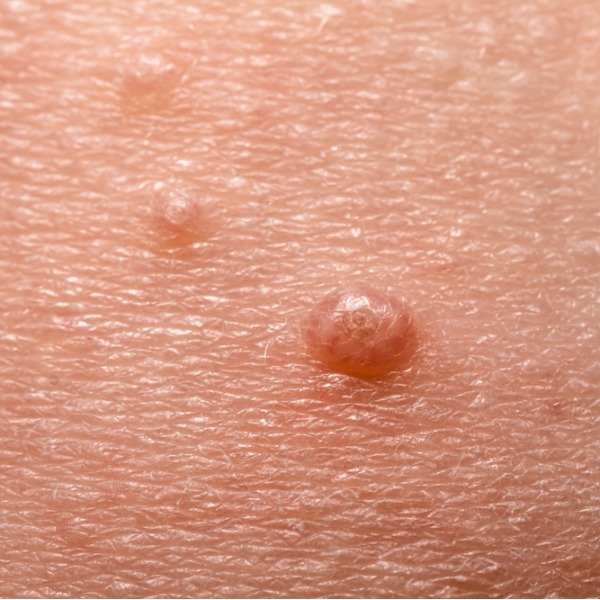 Моллюски, папилломы, бородавки: как избавиться от неэстетичных образований на коже