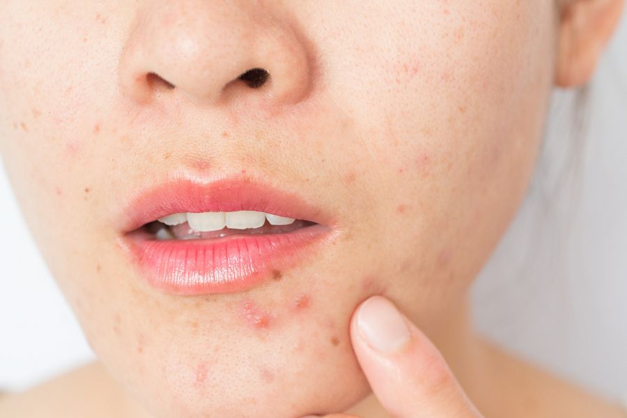 acne%2520stock_900.jpg