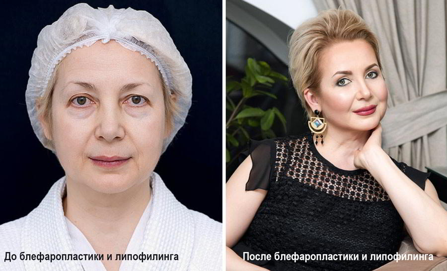 блефаропластика.jpg блефаропластика.jpg