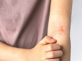 Там, где зудит и шелушится: как ухаживать за кожей при экземе в зависимости от локализации проблемы