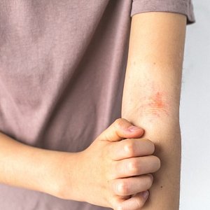 Там, где зудит и шелушится: как ухаживать за кожей при экземе в зависимости от локализации проблемы