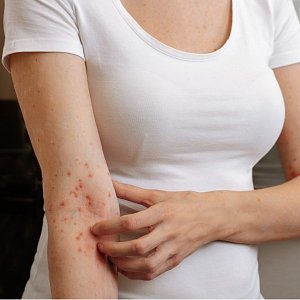 Красный плоский лишай: главные симптомы и провоцирующие факторы