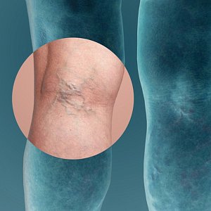 Что такое варикоз и почему он возникает