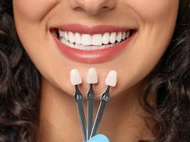 Тренды в эстетической стоматологии: форма, цвет, прозрачность. Какие виниры выбирают сейчас?