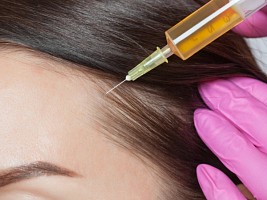 Кровь в голову: чем может быть полезна плазмотерапия волос