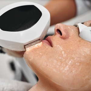 Плюсы и минусы фотоомоложения лица