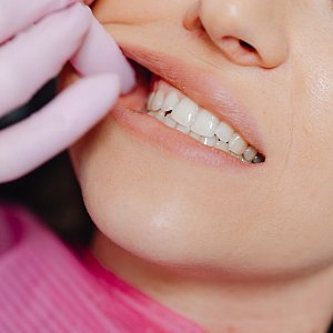 Зубной протез «бабочка»: как временно прикрыть отсутствие зуба