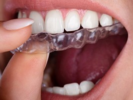 Скученность зубов: почему так важно исправить дефект