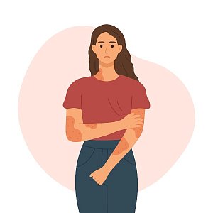 5 мифов об экземе, в которые нужно перестать верить 5 мифов об экземе, в которые нужно перестать верить