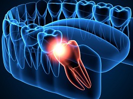 «Мудрые» зубы – зачем они нужны?