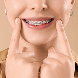 Сняли и опять поставили: 5 случаев, когда брекеты приходится ставить повторно