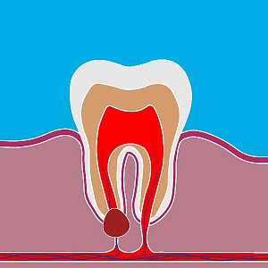 Киста зуба: как вовремя распознать, и чем она может быть опасна