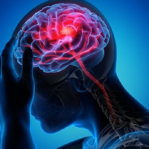 Цереброваскулярные заболевания: что это такое и насколько опасно Цереброваскулярные заболевания: что это такое и насколько опасно