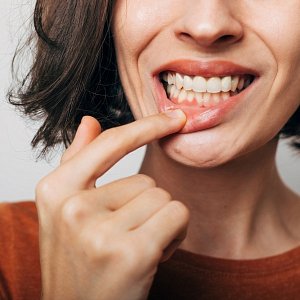 Стоматит: от чего появляются язвочки во рту и как их лечить?