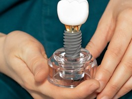 Имплант после удаления зуба: поспешить или повременить?