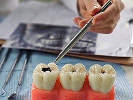 Можно ли остановить кариес без пломбы, если он уже начался: вся правда от стоматолога