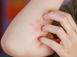 Неужели это лишай? Всегда ли заразно это заболевание и какие его разновидности встречаются