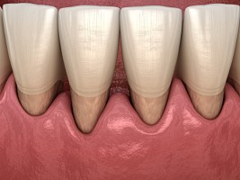 Почему оголяются шейки зубов: тревожные признаки рецессии десны и что с этим делать