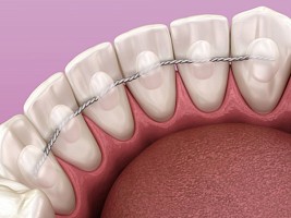 Держать за зубами: что такое несъемные ретейнеры в стоматологии
