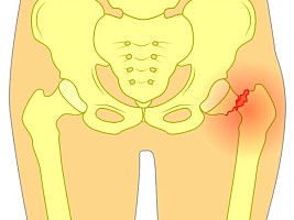 Перелом шейки бедра: тяжелая травма «на ровном месте»