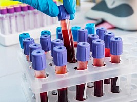Генетики определили связь между группой крови и течением заболевания COVID-19
