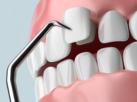 Виниры E-max vs композит: что дешевле и долговечнее для голливудской улыбки в 2026 году