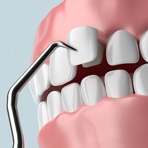 Виниры E-max vs композит: что дешевле и долговечнее для голливудской улыбки в 2026 году