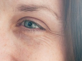 «Гусиные лапки»: что действительно помогает против морщин в уголках глаз