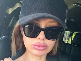 «Сделала ботокс»: после комплексной пластики лица Виктория Боня взялась за шею