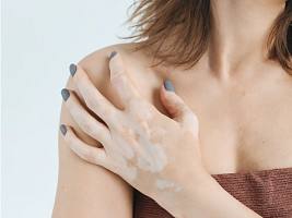 Витилиго: что это за болезнь и можно ли ее вылечить