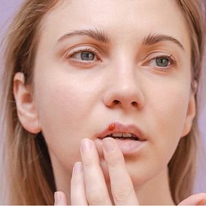 Герпес: как с ним жить? 