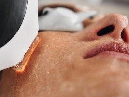 Можно ли делать фотоомоложение летом