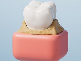 Невидимый враг улыбки: почему зубной камень старит лицо и запускает кариес