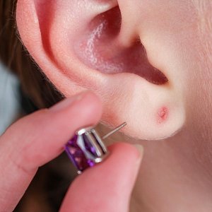 Аллергия на бижутерию в ушах: причины, симптомы и лечение