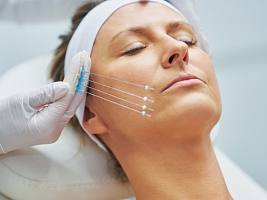 Механизм действия нитей: как именно формируется каркас и стимулируется коллаген?