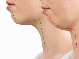 Мьюинг: можно ли изменить форму лица с помощью упражнений