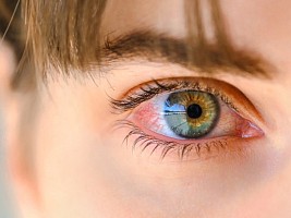 Глаз красный и болит: что такое конъюнктивит, причины появления и способы лечения