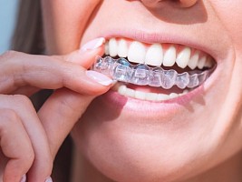 Брекеты во взрослом возрасте: насколько это эффективно и комфортно
