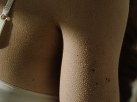 Будто гусиная кожа: как избавиться от фолликулярного гиперкератоза