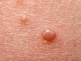 Моллюски, папилломы, бородавки: как избавиться от неэстетичных образований на коже