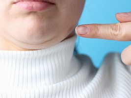 Можно ли нитями убрать второй подбородок