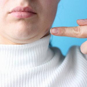 Можно ли нитями убрать второй подбородок