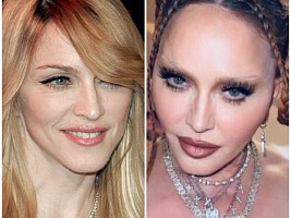 «Считает, что выглядит на 35»: почему Мадонна не перестанет использовать филлеры, несмотря на насмешки